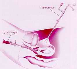 gynecology-today-laparoskopisi-isteroskopisi