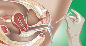 gynecology-today-spermategxusi